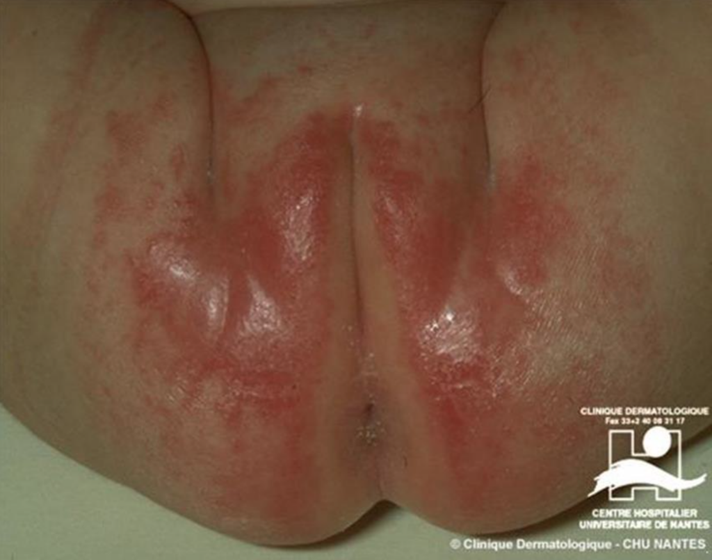 Erythèmes fessiers/ Dermites du siège – Merckx Pédiatrie