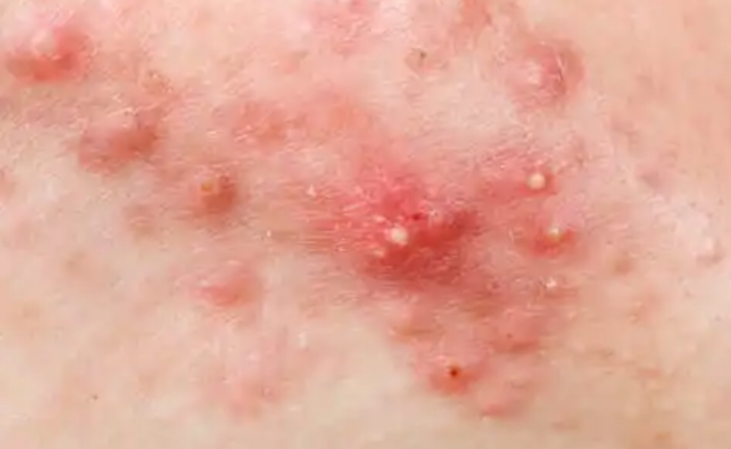 Erythèmes fessiers/ Dermites du siège – Merckx Pédiatrie